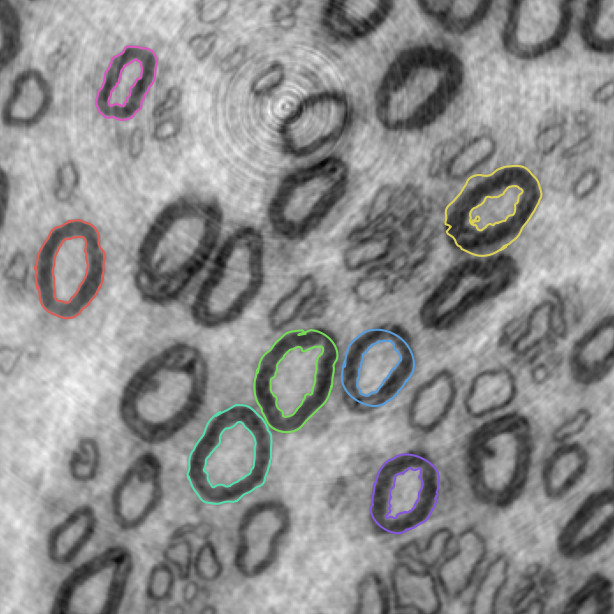 Nerve Segmentation